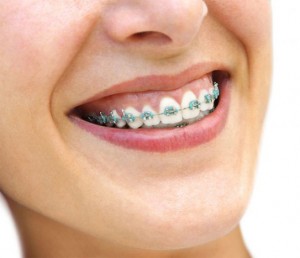 orthodontics Kent